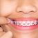 Types Of Dental Braces And Their Functions