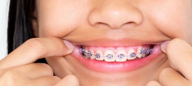 Types Of Dental Braces And Their Functions