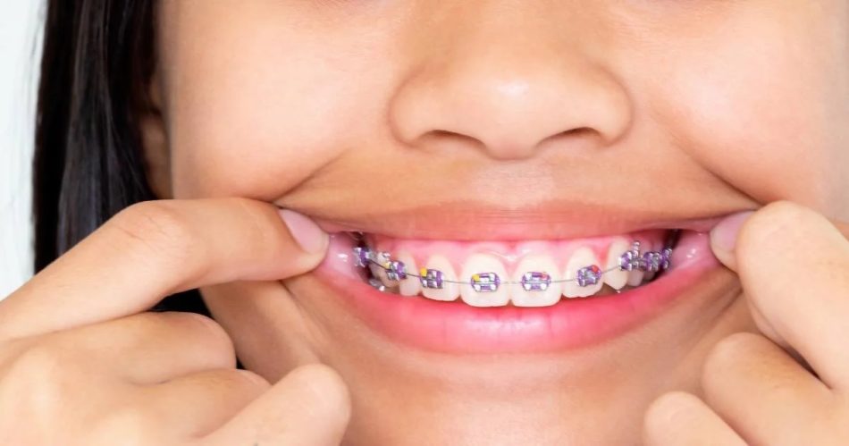 Types Of Dental Braces And Their Functions