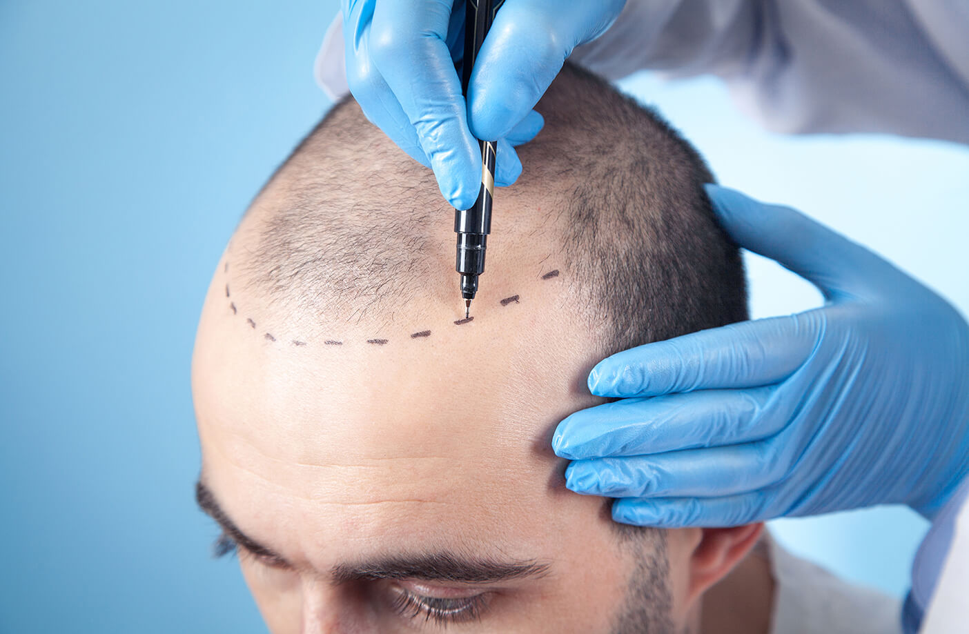 What Makes Hair Transplants So Popular